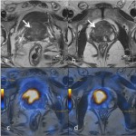 Fig 1: High resolution T2W axial images of the prostate at the level of base (a) and mid gland (b) shows large T2 hypointense lesions (arrows). The corresponding PSMA PET-MRI fusion images (c & d) correlates and confirms with location of the lesions.