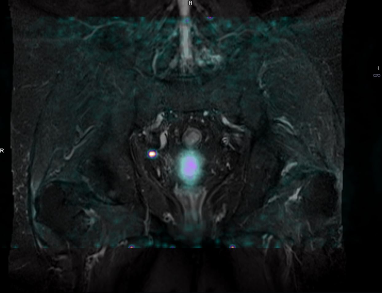 Lymph node metastases after prostatectomy, 68Ga-PSMA-PET/MRI
