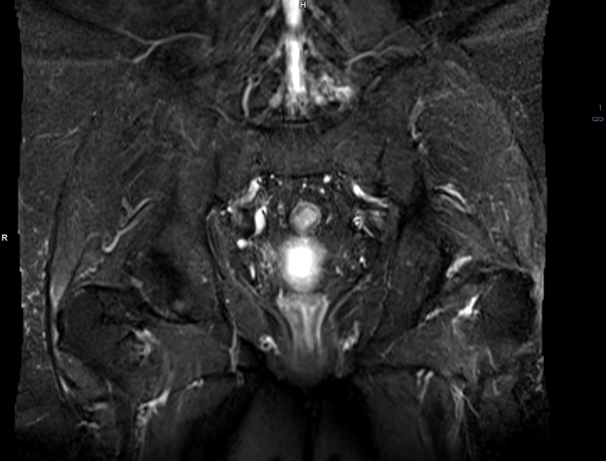 Lymph node metastases after prostatectomy, MRI